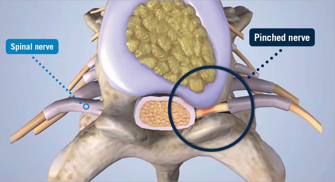 Sciatica Pain: What Binge-Watching Netflix Could Be Doing to Your Spine #Netflix #QuarneriChiropractic #SpinalDecompression