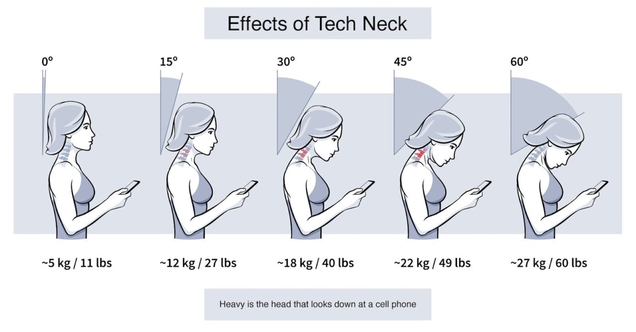 Tech Neck, Forward Head Posture, and Kyphosis: The New “Silent Epidemic” #Chiropractor #NeckInjury #QuarneriChiropractic